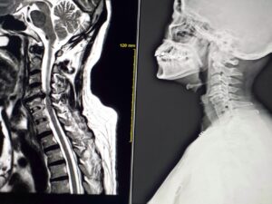 Seattle spinal cord injury lawyer helping injured client