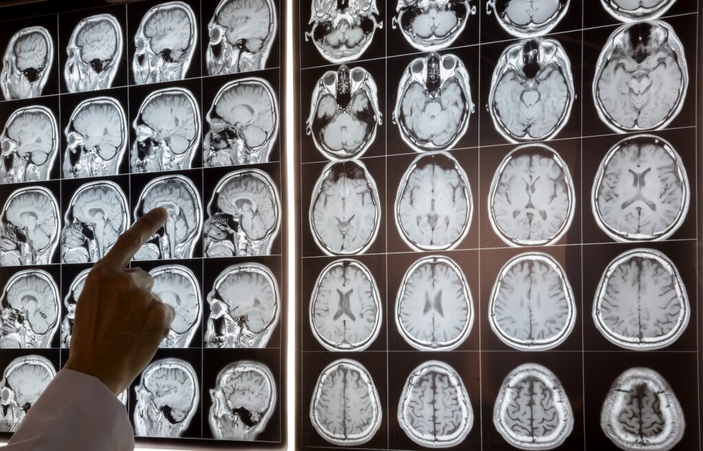 Traumatic Brain Injury Lawsuits Washington Guide
