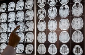 Traumatic Brain Injury Lawsuits Washington Guide